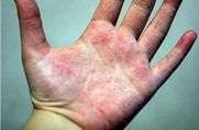 excessive sweating and eczema