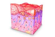 hyperhidrosis eczematous skin
