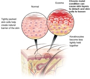 hyperhidrosis and over moistured skin