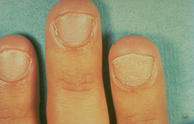 typical look of brittle nails