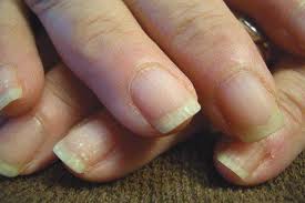soft fragile nails
