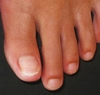 brittle toenails